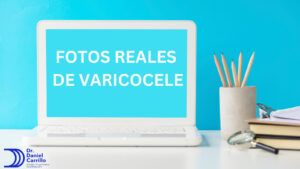 Conoce fotos reales de varicocele