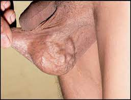 Masculino de 37 años con varicocele clínico e imagen de bolsa de gusanos
