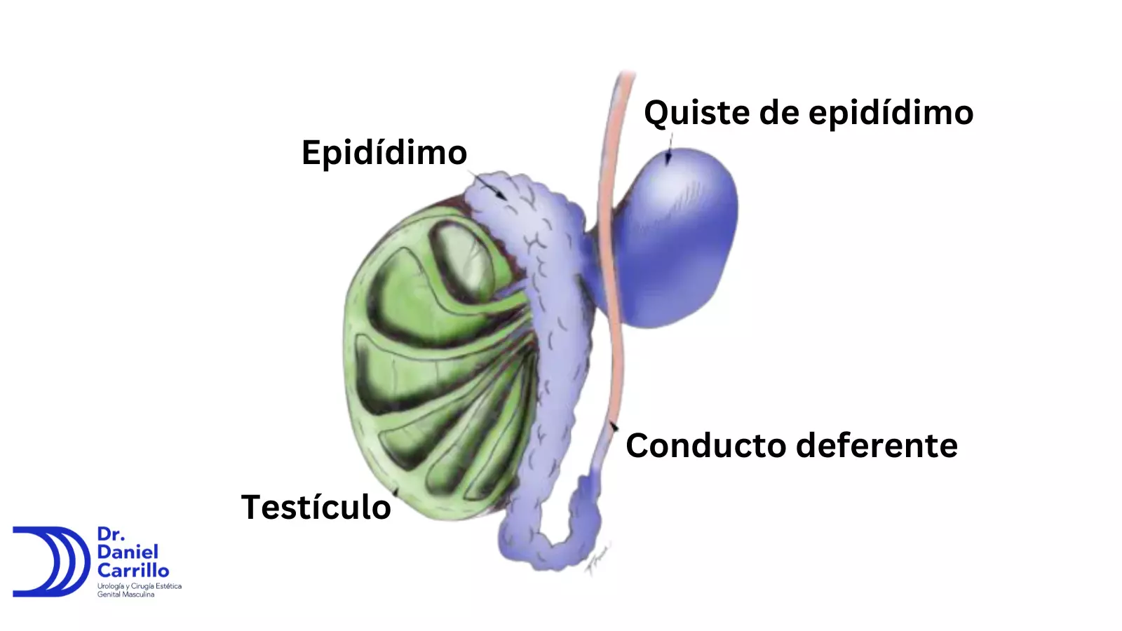 Quiste de epidídimo y espermatocele - Urólogo Daniel Carrillo