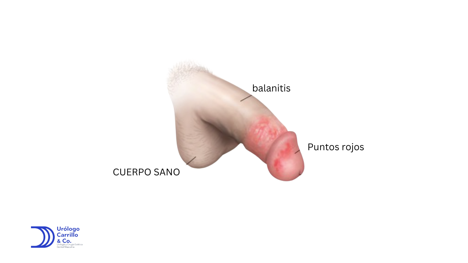 Penes arrugados