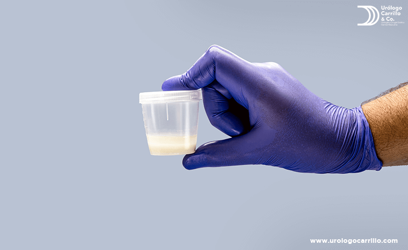 Después de una vasectomía, los espermatozoides ya no forman parte del semen
