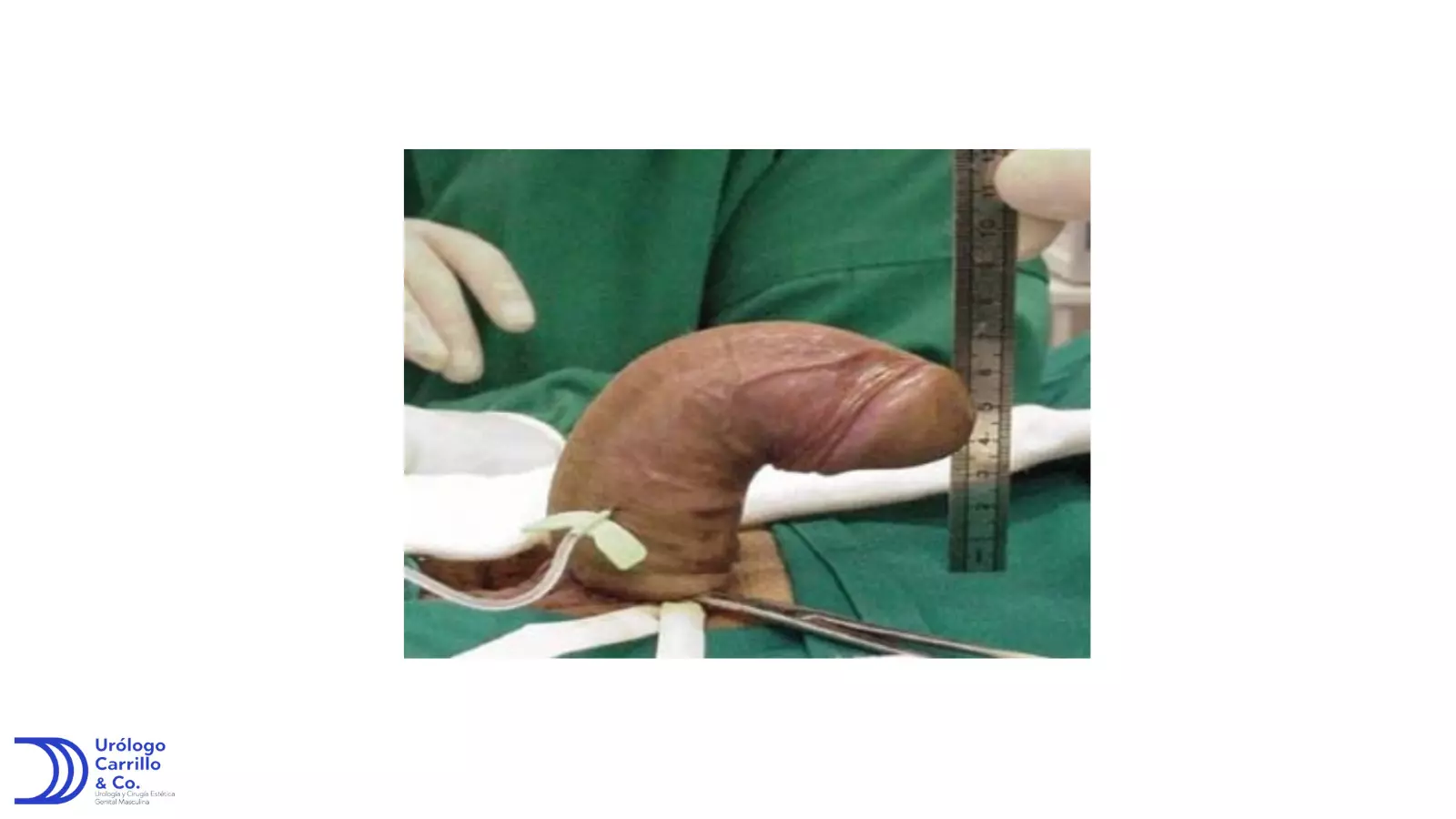 Foto de paciente con enfermedad de peyronie con pene con curvatura superior