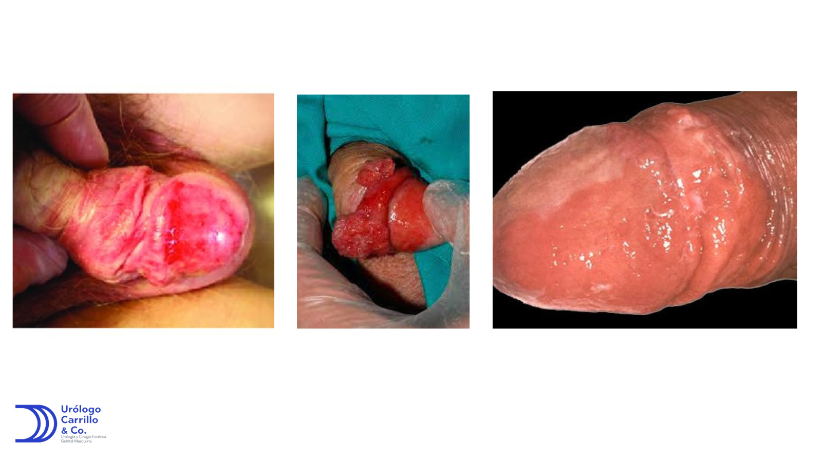 Eritroplasia de queyrat por VPH es una lesión que puede avanzar a cáncer 