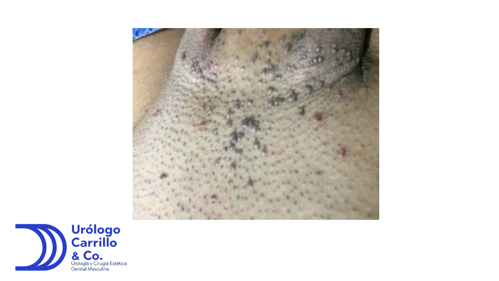 Verrugas genitales causadas por VPH que simulan lunares