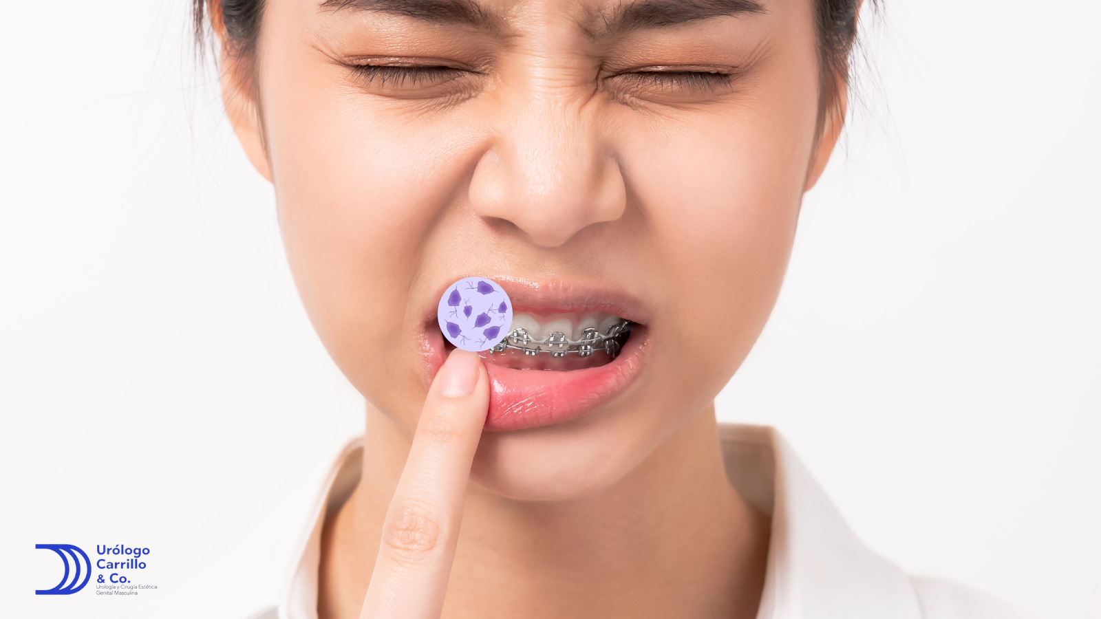 Hay muchos tipos de verruga por VPH que pueden salir en boca