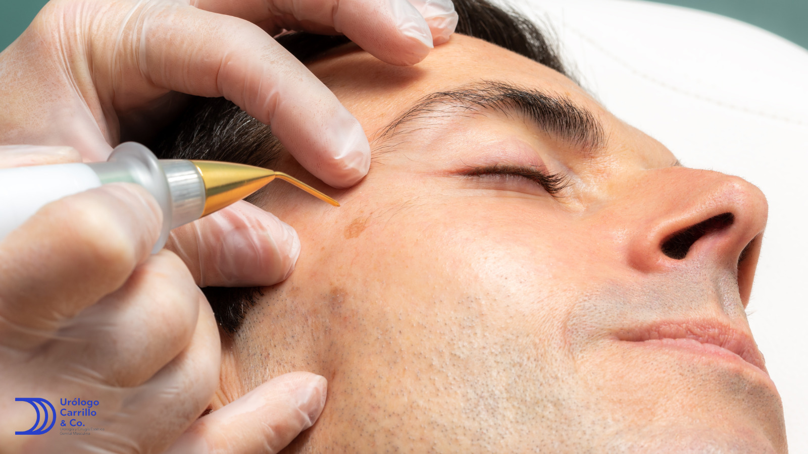 cirugía láser para verrugas genitales en hombres
