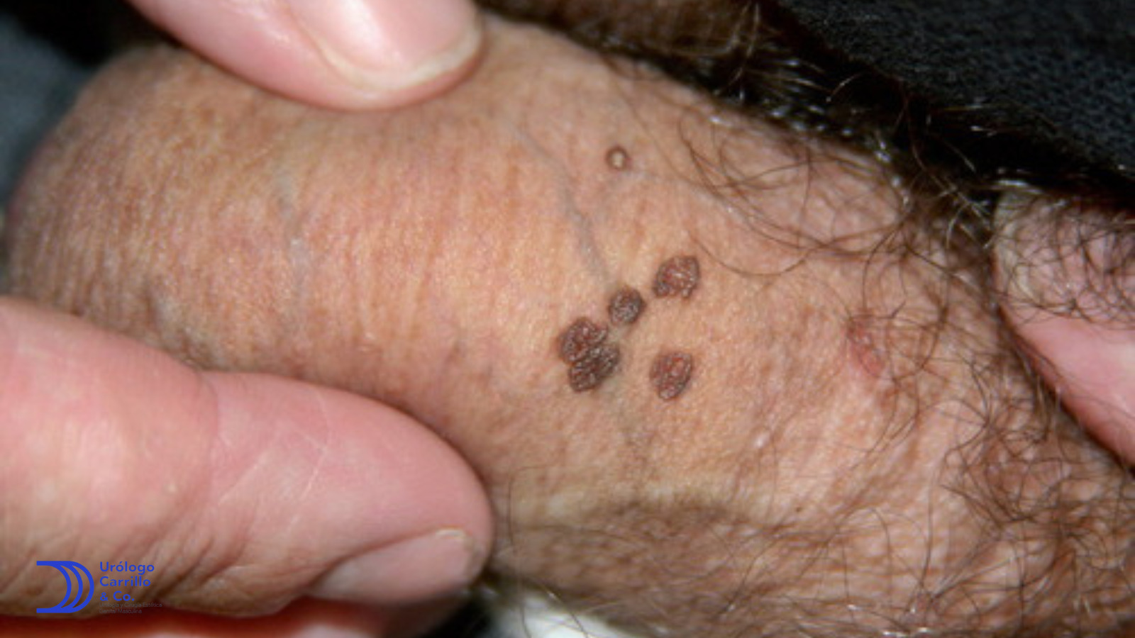 VPH en hombre manifestado como múltiples verrugas cafés en el cuerpo del pene
