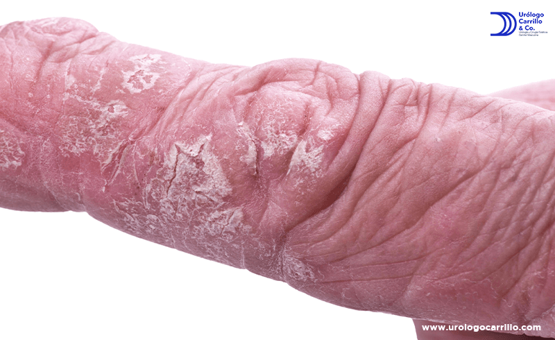 Cualquier mancha cambio en la coloración o textura de la piel genital debe revisarse por un experto