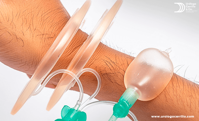 La prótesis de pene semirrígida es la solución para hombres con disfunción eréctil.